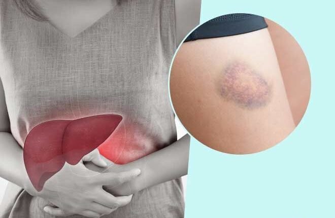 'Skinny Fat' Fatty Liver: A hidden health crisis growing rapidly among young people