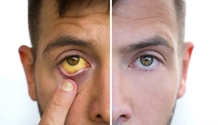 Advisory issued to prevent cholera and jaundice