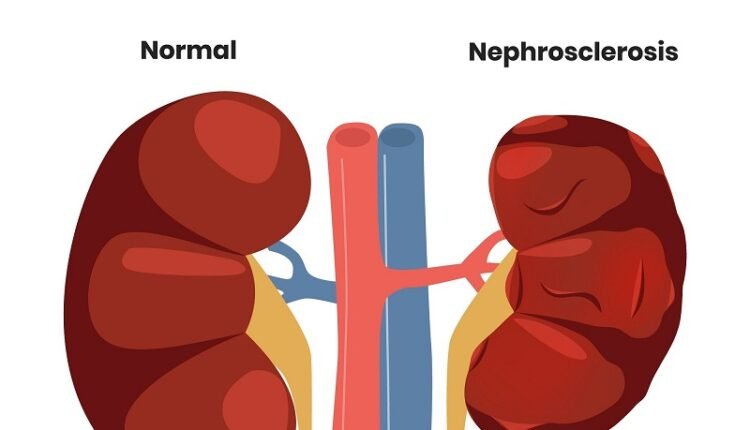 "Early signs of kidney damage can be seen in the eyes; learn why doctors have issued this warning."